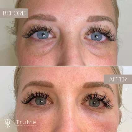 PRP Before and after